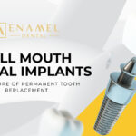 Why Full Mouth Dental Implants Are the Future of Permanent Tooth Replacement